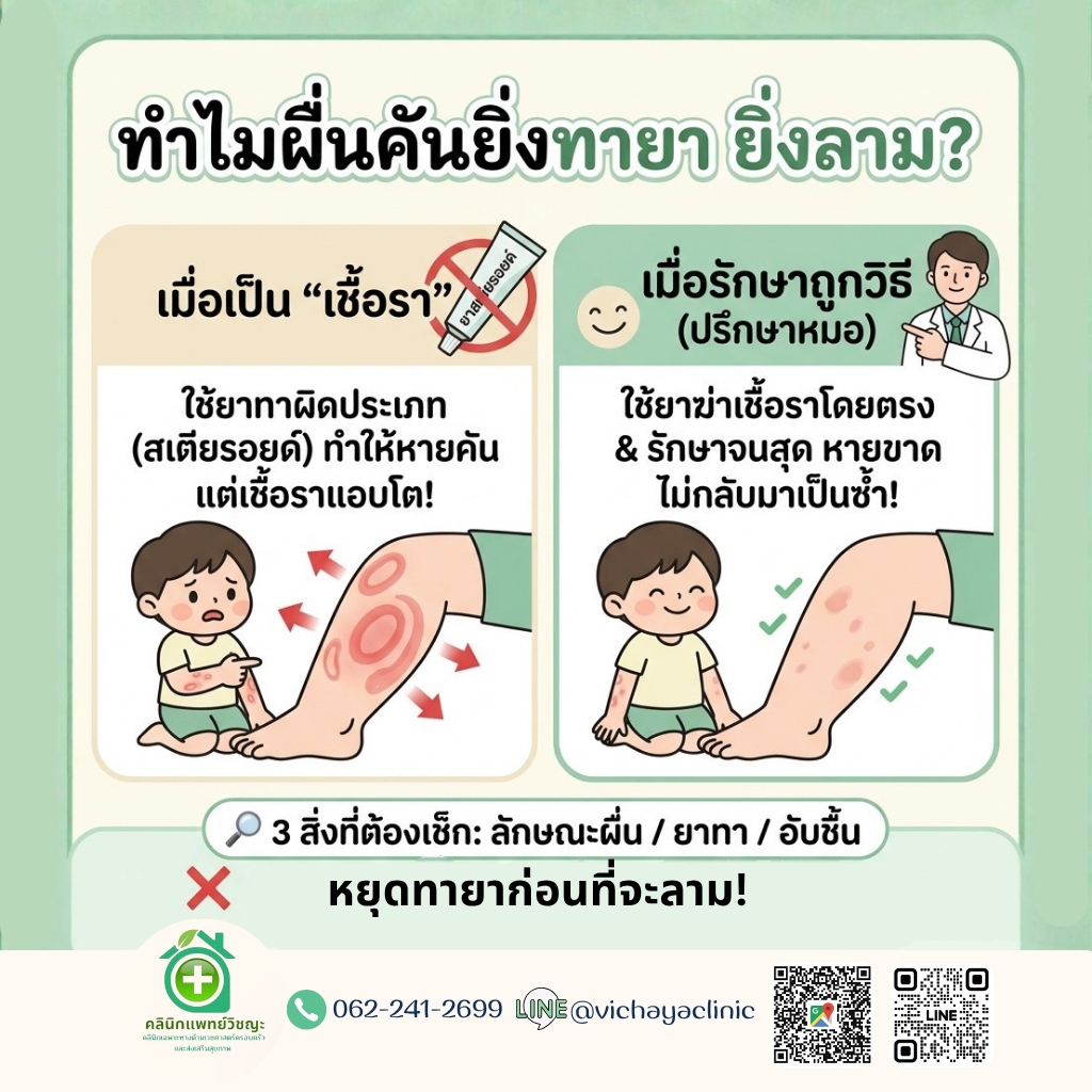 คลินิกโรคผิวหนังเชื้อราหาดใหญ่ รักษาเชื้อราผิวหนัง กลาก เกลื้อน ยาทาเชื้อรา ยาฆ่าเชื้อรา คลินิกผิวหนังหาดใหญ่ คลินิกแพทย์วิชญะ